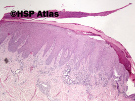 1. Łuszczyca (psoriasis), 4x