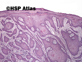 1. Rak płaskonabłonkowy (squamous cell carcinoma), 4x