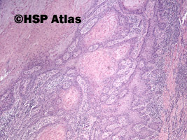 2. Rak płaskonabłonkowy (squamous cell carcinoma), 4x