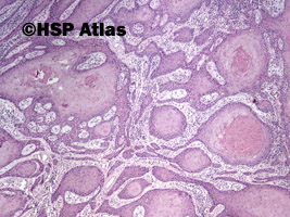 4. Rak płaskonabłonkowy (squamous cell carcinoma), 4x