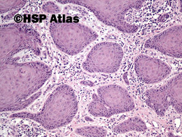 5. Rak płaskonabłonkowy (squamous cell carcinoma), 10x