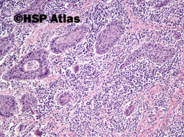 6. Rak płaskonabłonkowy (squamous cell carcinoma), 10x