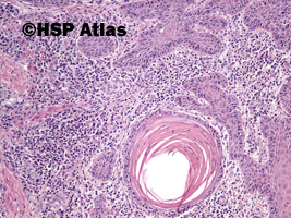 7. Rak płaskonabłonkowy (squamous cell carcinoma), 10x