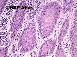 8. Rak płaskonabłonkowy (squamous cell carcinoma), 20x