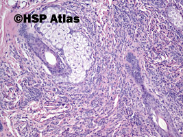 4. Znamię melanocytarne wrodzone (congenital melanocytic nevus), 10x