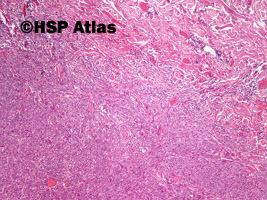 3. Czerniak, postać guzkowa (nodular melanoma), 4x