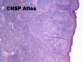 2. Czerniak, postać guzkowa (nodular melanoma), 4x