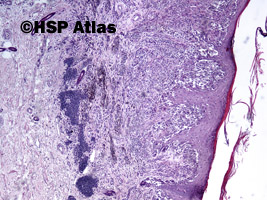 1. Czerniak o wzroście powierzchownym (superficial spreading melanoma - SSM), 4x