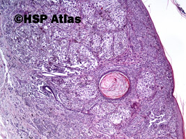2. Czerniak o wzroście powierzchownym (superficial spreading melanoma - SSM), 4x