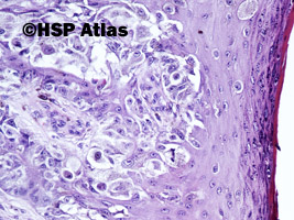 9. Czerniak o wzroście powierzchownym (superficial spreading melanoma - SSM), 20x