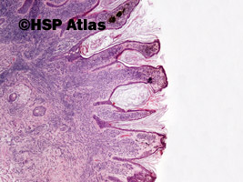 2. Znamię barwnikowe śródskórne brodawkowate (verrucous intradermal melanocytic nevus), 4x