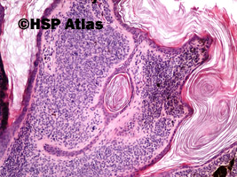 3. Znamię barwnikowe śródskórne brodawkowate (verrucous intradermal melanocytic nevus), 10x