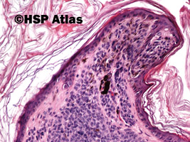 4. Znamię barwnikowe śródskórne brodawkowate (verrucous intradermal melanocytic nevus), 20x