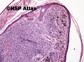 5. Znamię barwnikowe śródskórne brodawkowate (verrucous intradermal melanocytic nevus), 10x