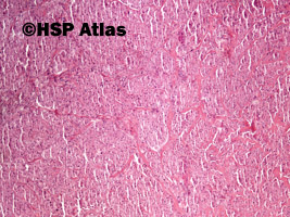 1. Guz Abrikosowa, guz ziarnistokomórkowy (granular cell myoblastoma, Abrikosoff tumor), łopatka, 4x