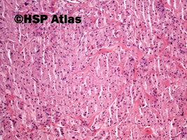 2. Guz Abrikosowa, guz ziarnistokomórkowy (granular cell myoblastoma, Abrikosoff tumor), łopatka, 10x
