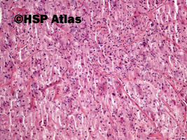 3. Guz Abrikosowa, guz ziarnistokomórkowy (granular cell myoblastoma, Abrikosoff tumor), łopatka, 10x