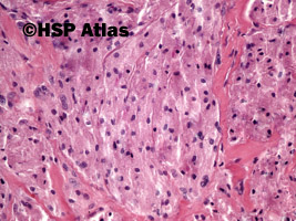 4. Guz Abrikosowa, guz ziarnistokomórkowy (granular cell myoblastoma, Abrikosoff tumor), łopatka, 20x