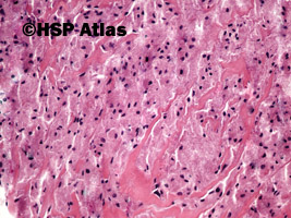 5. Granular cell myoblastoma, Abrikosoff tumor, 20x