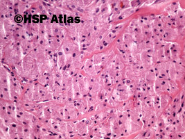 6. Guz Abrikosowa, guz ziarnistokomórkowy (granular cell myoblastoma, Abrikosoff tumor), łopatka, 20x