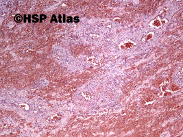 2. Naczyniakomięsak (angiosarcoma), 4x