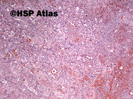 3. Naczyniakomięsak (angiosarcoma), 4x