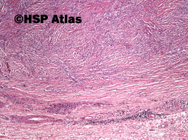 1. Łagodny włókniak histiocytarny (benign fibrous histiocytoma), 4x