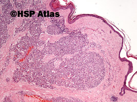 1. Naczyniak włośniczkowy (capillary hemangioma), 4x