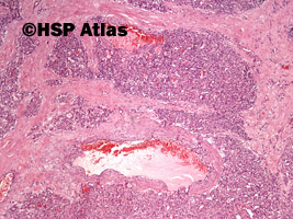 2. Naczyniak włośniczkowy (capillary hemangioma), 4x