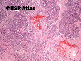 3. Naczyniak włośniczkowy (capillary hemangioma), 4x