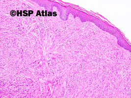1. Mięsak gładkokomórkowy skóry (Cutaneous leiomyosarcoma)