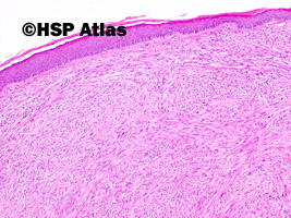 2. Mięsak gładkokomórkowy skóry (Cutaneous leiomyosarcoma)