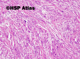 3. Mięsak gładkokomórkowy skóry (Cutaneous leiomyosarcoma)
