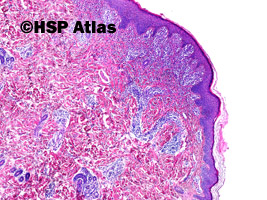 1. Mastocytoza skóry (cutaneous mastocytosis)
