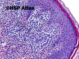 2. Mastocytoza skóry (cutaneous mastocytosis)