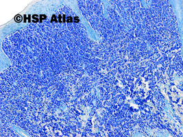 3. Mastocytoza skóry (cutaneous mastocytosis), błękit alcjanu