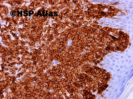 4. Mastocytoza skóry (cutaneous mastocytosis), CD117