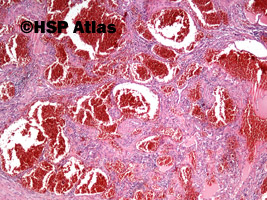 1. Naczyniak krwionośny jamisty (cavernous haemangioma), 4x