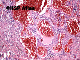 3. Naczyniak krwionośny jamisty (cavernous haemangioma), 10x