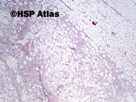 1. Tłuszczak zarodkowy (lipoblastoma), 4x
