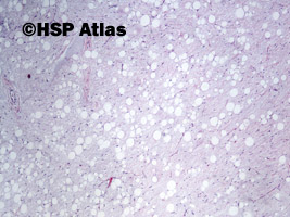 2. Tłuszczak zarodkowy (lipoblastoma), 4x