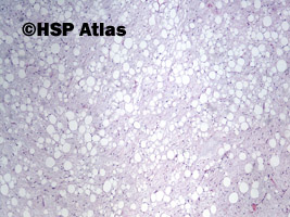 3. Tłuszczak zarodkowy (lipoblastoma), 4x