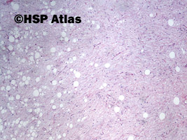 4. Lipoblastoma, 4x