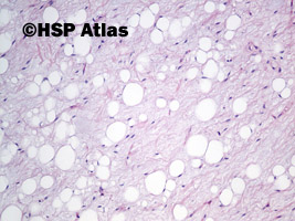 6. Tłuszczak zarodkowy (lipoblastoma), 10x