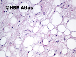 7. Tłuszczak zarodkowy (lipoblastoma), 20x