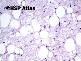 8. Tłuszczak zarodkowy (lipoblastoma), 20x