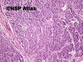 2. Rak z komórek Merkla (Merkel cell carcinoma), 10x