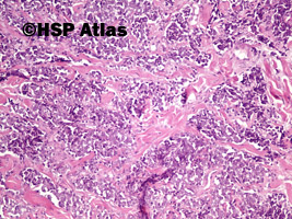 3. Rak z komórek Merkla (Merkel cell carcinoma), 10x