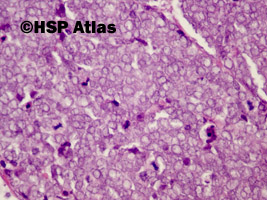 5. Rak z komórek Merkla (Merkel cell carcinoma), 40x