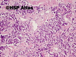 7. Rak z komórek Merkla (Merkel cell carcinoma), 20x